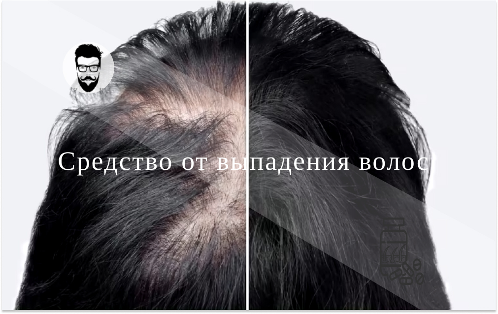 Алопеция: причины, лечение и профилактика выпадения волос