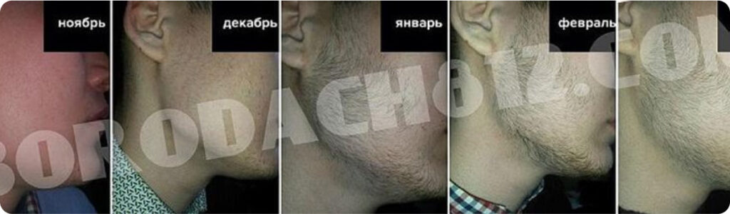 Результат применения миноксидила